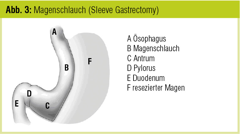 Forum magenbypass Forum